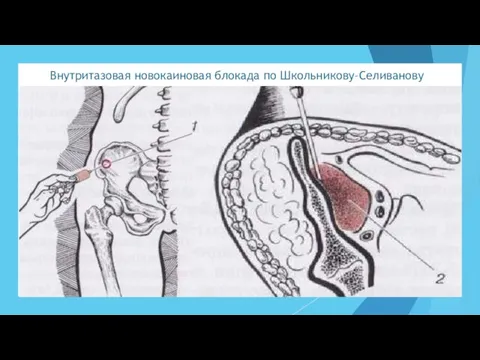 Внутритазовая новокаиновая блокада по Школьникову–Селиванову