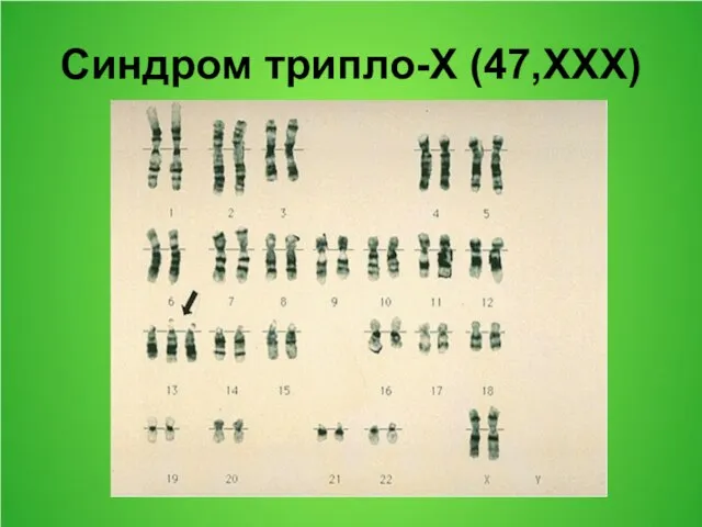 Синдром трипло-Х (47,ХХХ)