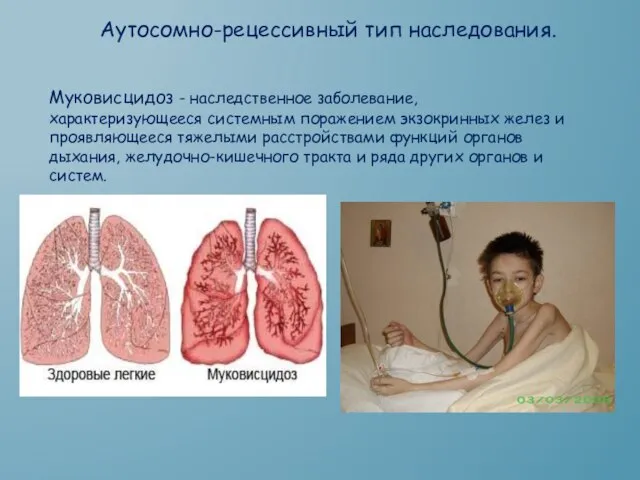 Аутосомно-рецессивный тип наследования. Муковисцидоз - наследственное заболевание, характеризующееся системным поражением экзокринных желез