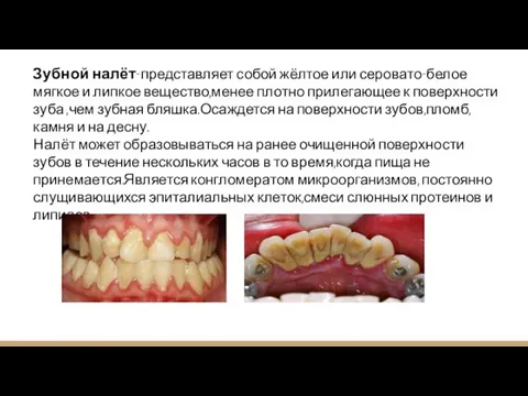 Зубной налёт-представляет собой жёлтое или серовато-белое мягкое и липкое вещество,менее плотно прилегающее