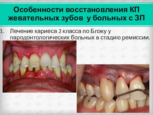 Особенности восстановления КП жевательных зубов у больных с ЗП Лечение кариеса 2