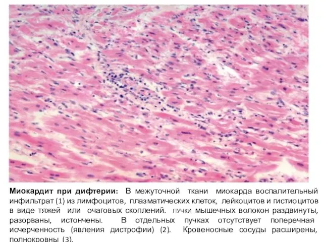 Миокардит при дифтерии: В межуточной ткани миокарда воспалительный инфильтрат (1) из лимфоцитов,