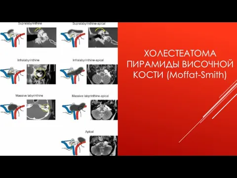 ХОЛЕСТЕАТОМА ПИРАМИДЫ ВИСОЧНОЙ КОСТИ (Moffat-Smith)