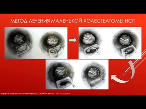 МЕТОД ЛЕЧЕНИЯ МАЛЕНЬКОЙ ХОЛЕСТЕАТОМЫ НСП Хирургия наружного слухового прохода в 4 томах, М.Тос, 3 том стр205-218)