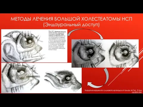 МЕТОДЫ ЛЕЧЕНИЯ БОЛЬШОЙ ХОЛЕСТЕАТОМЫ НСП (Эндауральный доступ) Хирургия наружного слухового прохода в