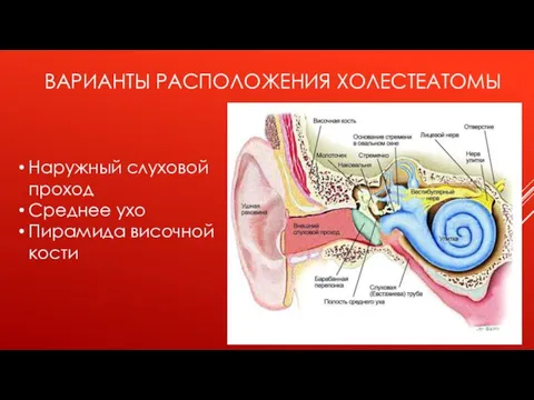 ВАРИАНТЫ РАСПОЛОЖЕНИЯ ХОЛЕСТЕАТОМЫ Наружный слуховой проход Среднее ухо Пирамида височной кости