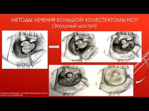 МЕТОДЫ ЛЕЧЕНИЯ БОЛЬШОЙ ХОЛЕСТЕАТОМЫ НСП (Заушный доступ) Хирургия наружного слухового прохода в