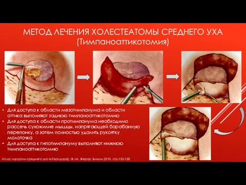 МЕТОД ЛЕЧЕНИЯ ХОЛЕСТЕАТОМЫ СРЕДНЕГО УХА (Тимпаноаттикотомия) Для доступа к области мезотимпанума и