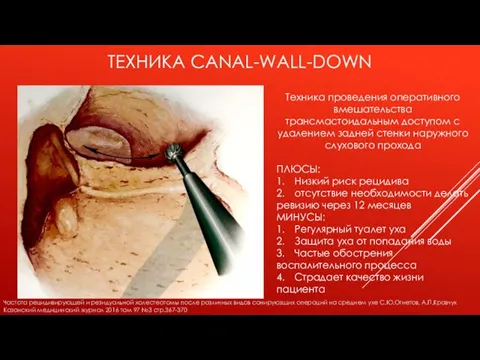 ТЕХНИКА CANAL-WALL-DOWN Техника проведения оперативного вмешательства трансмастоидальным доступом с удалением задней стенки