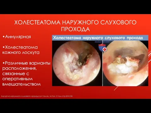 ХОЛЕСТЕАТОМА НАРУЖНОГО СЛУХОВОГО ПРОХОДА •Аннулярная •Холестеатома кожного лоскута •Различные варианты расположения, связанные