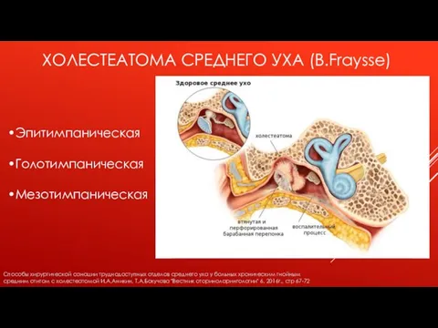 ХОЛЕСТЕАТОМА СРЕДНЕГО УХА (B.Fraysse) •Эпитимпаническая •Голотимпаническая •Мезотимпаническая Способы хирургической санации труднодоступных отделов