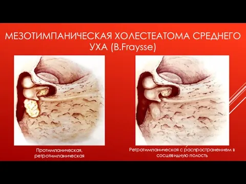 МЕЗОТИМПАНИЧЕСКАЯ ХОЛЕСТЕАТОМА СРЕДНЕГО УХА (B.Fraysse) Протимпаническая, ретротимпаническая Ретротимпаническая с распространением в сосцевидную полость