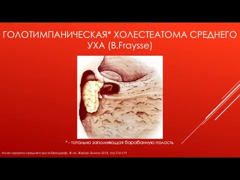 ГОЛОТИМПАНИЧЕСКАЯ* ХОЛЕСТЕАТОМА СРЕДНЕГО УХА (B.Fraysse) * - тотально заполняющая барабанную полость Атлас