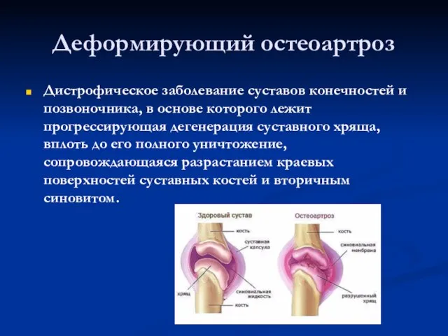 Деформирующий остеоартроз Дистрофическое заболевание суставов конечностей и позвоночника, в основе которого лежит