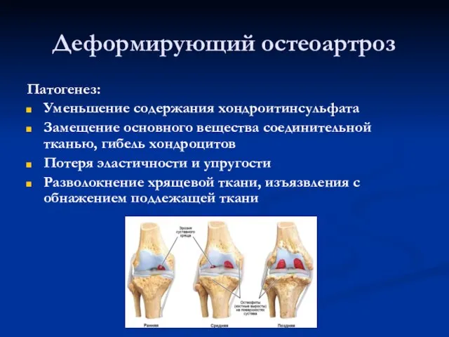 Деформирующий остеоартроз Патогенез: Уменьшение содержания хондроитинсульфата Замещение основного вещества соединительной тканью, гибель