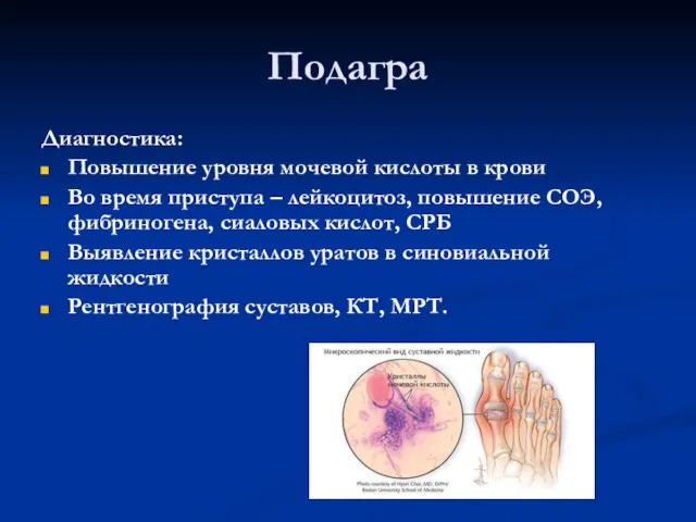 Подагра Диагностика: Повышение уровня мочевой кислоты в крови Во время приступа –