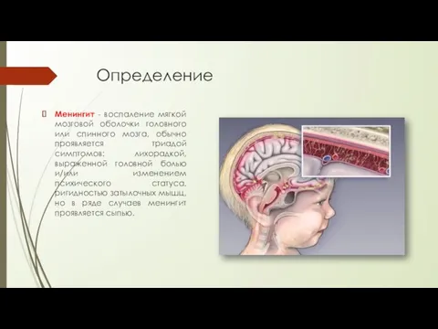 Определение Менингит - воспаление мягкой мозговой оболочки головного или спинного мозга, обычно