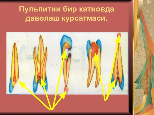 Пульпитни бир катновда даволаш курсатмаси.