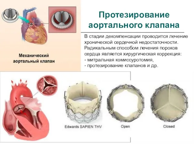 Протезирование аортального клапана В стадии декомпенсации проводится лечение хронической сердечной недостаточности. Радикальным