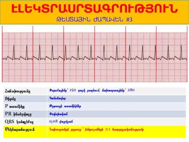 1 ԷԼԵԿՏՐԱՍՐՏԱԳՐՈՒԹՅՈՒՆ ԹԵՍՏԱՅԻՆ ԺԱՊԱՎԵՆ #3 Փորոքայինը՝ 150 զարկ րոպեում, նախասրտայինը՝ 280 Կանոնավոր