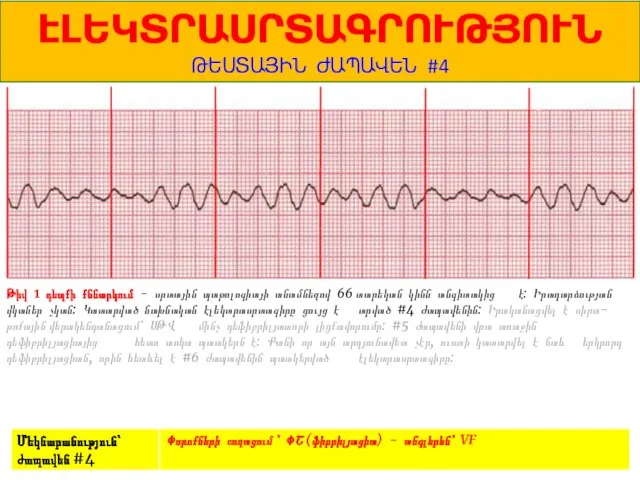 1 ԷԼԵԿՏՐԱՍՐՏԱԳՐՈՒԹՅՈՒՆ ԹԵՍՏԱՅԻՆ ԺԱՊԱՎԵՆ #4 Թիվ 1 դեպքի քննարկում - սրտային պաթոլոգիայի