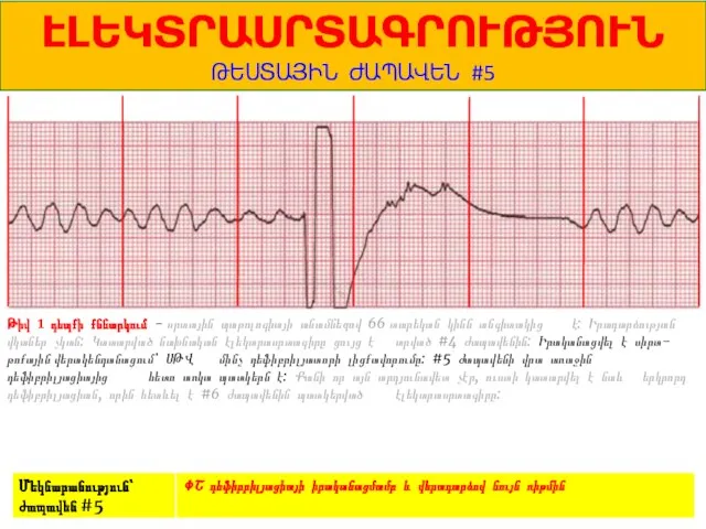 1 ԷԼԵԿՏՐԱՍՐՏԱԳՐՈՒԹՅՈՒՆ ԹԵՍՏԱՅԻՆ ԺԱՊԱՎԵՆ #5 Թիվ 1 դեպքի քննարկում - սրտային պաթոլոգիայի