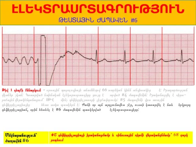 1 ԷԼԵԿՏՐԱՍՐՏԱԳՐՈՒԹՅՈՒՆ ԹԵՍՏԱՅԻՆ ԺԱՊԱՎԵՆ #6 Թիվ 1 դեպքի քննարկում - սրտային պաթոլոգիայի