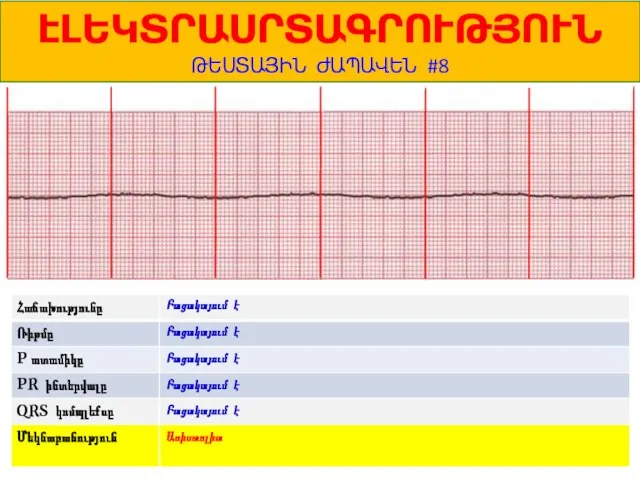 1 ԷԼԵԿՏՐԱՍՐՏԱԳՐՈՒԹՅՈՒՆ ԹԵՍՏԱՅԻՆ ԺԱՊԱՎԵՆ #8 Բացակայում է Բացակայում է Բացակայում է Բացակայում է Բացակայում է Ասիստոլիա