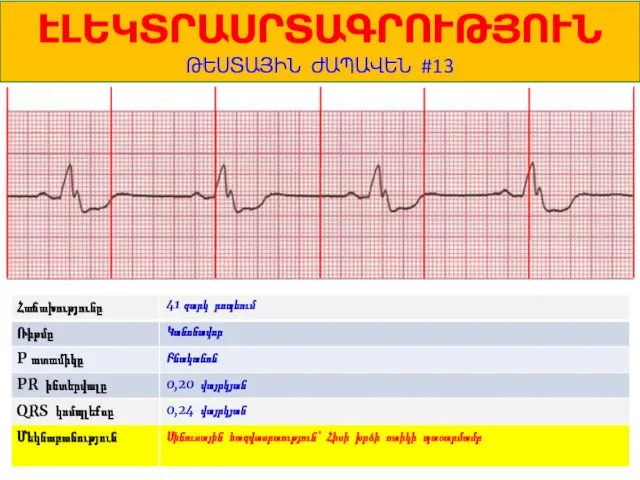 1 ԷԼԵԿՏՐԱՍՐՏԱԳՐՈՒԹՅՈՒՆ ԹԵՍՏԱՅԻՆ ԺԱՊԱՎԵՆ #13 41 զարկ րոպեում Կանոնավոր Բնականոն 0,20 վայրկյան