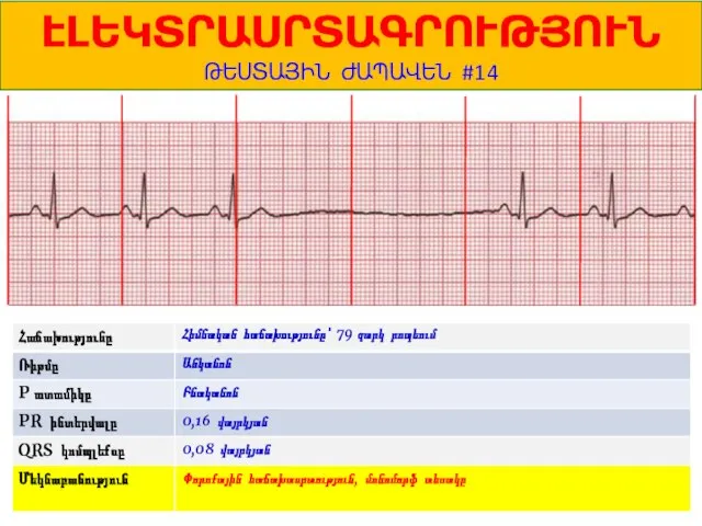 1 ԷԼԵԿՏՐԱՍՐՏԱԳՐՈՒԹՅՈՒՆ ԹԵՍՏԱՅԻՆ ԺԱՊԱՎԵՆ #14 Հիմնական հաճախությունը՝ 79 զարկ րոպեում Անկանոն Բնականոն