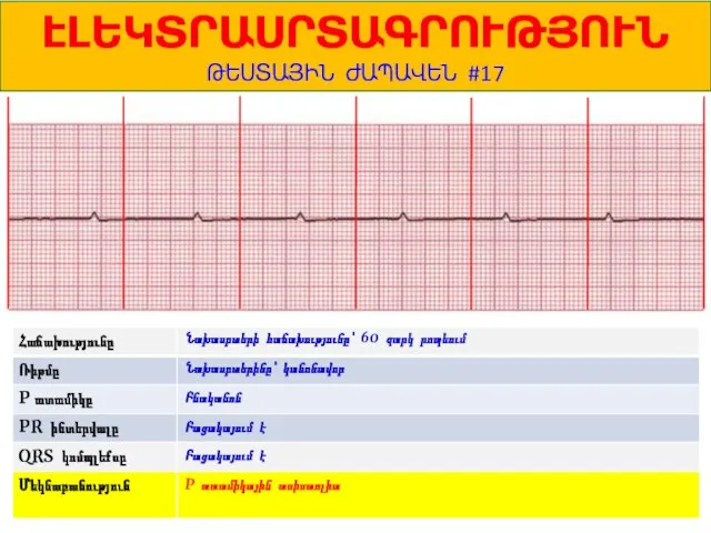 1 ԷԼԵԿՏՐԱՍՐՏԱԳՐՈՒԹՅՈՒՆ ԹԵՍՏԱՅԻՆ ԺԱՊԱՎԵՆ #17 Նախասրտերի հաճախությունը՝ 60 զարկ րոպեում Նախասրտերինը՝ կանոնավոր