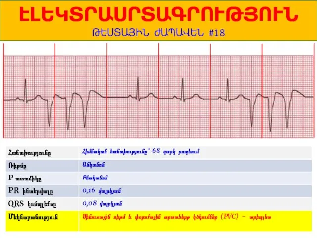 1 ԷԼԵԿՏՐԱՍՐՏԱԳՐՈՒԹՅՈՒՆ ԹԵՍՏԱՅԻՆ ԺԱՊԱՎԵՆ #18 Հիմնական հաճախությունը՝ 68 զարկ րոպեում Անկանոն Բնականոն