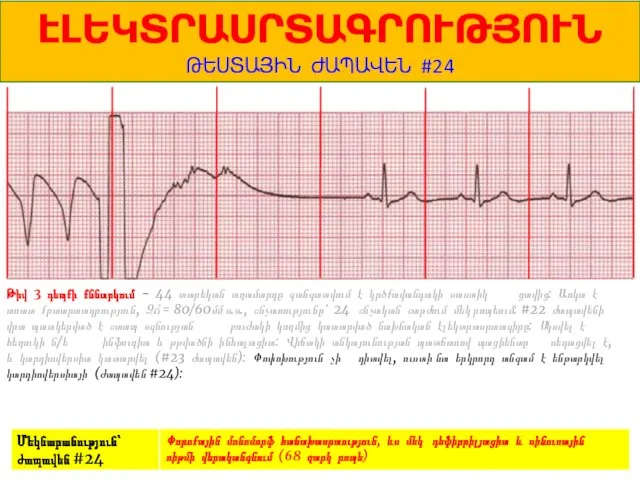 1 ԷԼԵԿՏՐԱՍՐՏԱԳՐՈՒԹՅՈՒՆ ԹԵՍՏԱՅԻՆ ԺԱՊԱՎԵՆ #24 Թիվ 3 դեպքի քննարկում - 44 տարեկան
