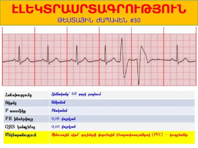 1 ԷԼԵԿՏՐԱՍՐՏԱԳՐՈՒԹՅՈՒՆ ԹԵՍՏԱՅԻՆ ԺԱՊԱՎԵՆ #30 Հիմնականը՝ 68 զարկ րոպեում Անկանոն Բնականոն 0,16