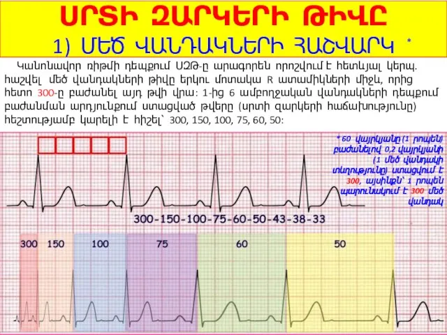 ՍՐՏԻ ԶԱՐԿԵՐԻ ԹԻՎԸ 1) ՄԵԾ ՎԱՆԴԱԿՆԵՐԻ ՀԱՇՎԱՐԿ Կանոնավոր ռիթմի դեպքում ՍԶԹ-ը արագորեն