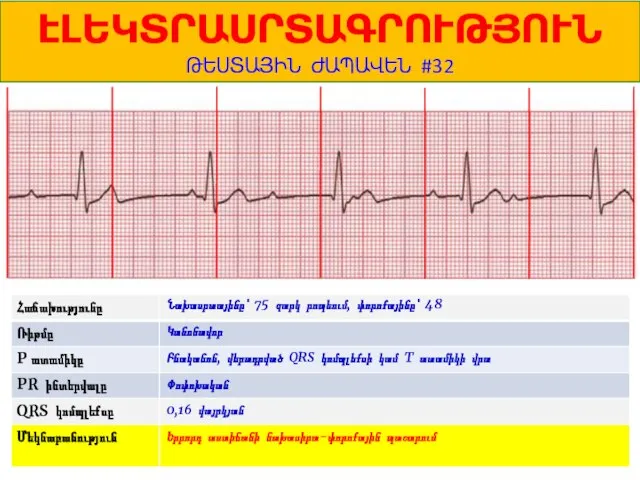 1 ԷԼԵԿՏՐԱՍՐՏԱԳՐՈՒԹՅՈՒՆ ԹԵՍՏԱՅԻՆ ԺԱՊԱՎԵՆ #32 Նախասրտայինը՝ 75 զարկ րոպեում, փորոքայինը՝ 48 Կանոնավոր