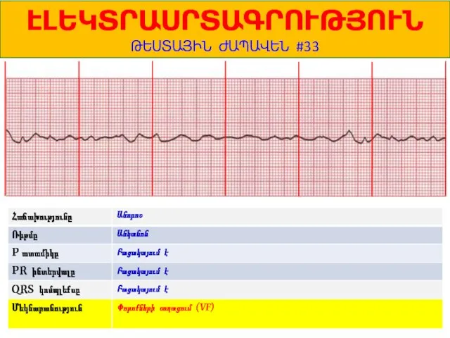 1 ԷԼԵԿՏՐԱՍՐՏԱԳՐՈՒԹՅՈՒՆ ԹԵՍՏԱՅԻՆ ԺԱՊԱՎԵՆ #33 Անորոշ Անկանոն Բացակայում է Բացակայում է Բացակայում է Փորոքների շողացում (VF)