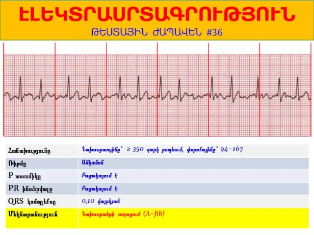 1 ԷԼԵԿՏՐԱՍՐՏԱԳՐՈՒԹՅՈՒՆ ԹԵՍՏԱՅԻՆ ԺԱՊԱՎԵՆ #36 Նախասրտայինը՝ ≥ 350 զարկ րոպեում, փորոքայինը՝ 94-167