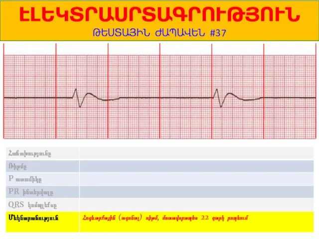 1 ԷԼԵԿՏՐԱՍՐՏԱԳՐՈՒԹՅՈՒՆ ԹԵՍՏԱՅԻՆ ԺԱՊԱՎԵՆ #37 Հոգևարքային (ագոնալ) ռիթմ, մոտավորապես 22 զարկ րոպեում