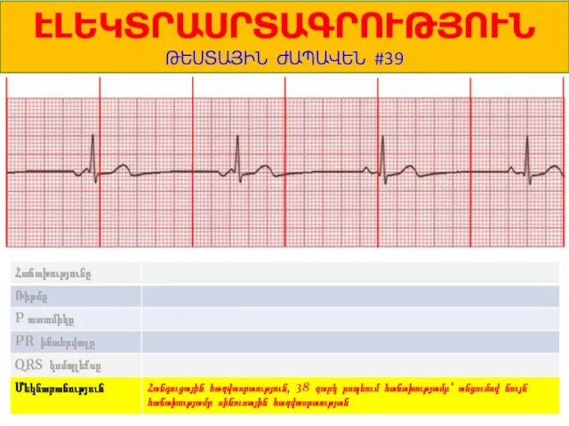 1 ԷԼԵԿՏՐԱՍՐՏԱԳՐՈՒԹՅՈՒՆ ԹԵՍՏԱՅԻՆ ԺԱՊԱՎԵՆ #39 Հանգուցային հազվասրտություն, 38 զարկ րոպեում հաճախությամբ՝ անցումով նույն հաճախությամբ սինուսային հազվասրտության