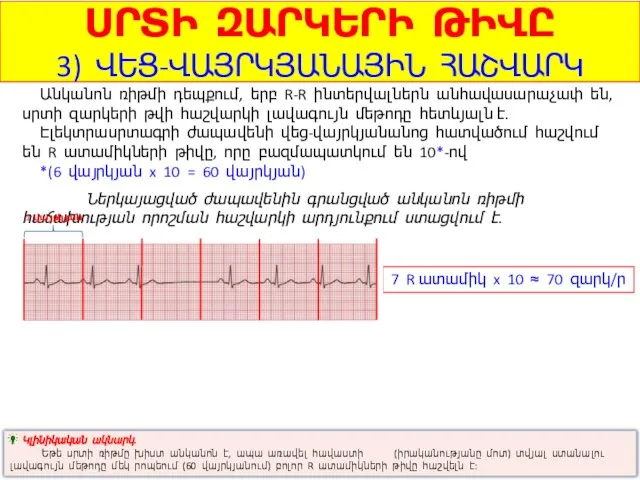 ՍՐՏԻ ԶԱՐԿԵՐԻ ԹԻՎԸ 3) ՎԵՑ-ՎԱՅՐԿՅԱՆԱՅԻՆ ՀԱՇՎԱՐԿ Անկանոն ռիթմի դեպքում, երբ R-R ինտերվալներն