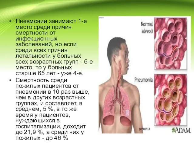 Пневмонии занимают 1-е место среди причин смертности от инфекционных заболеваний, но если