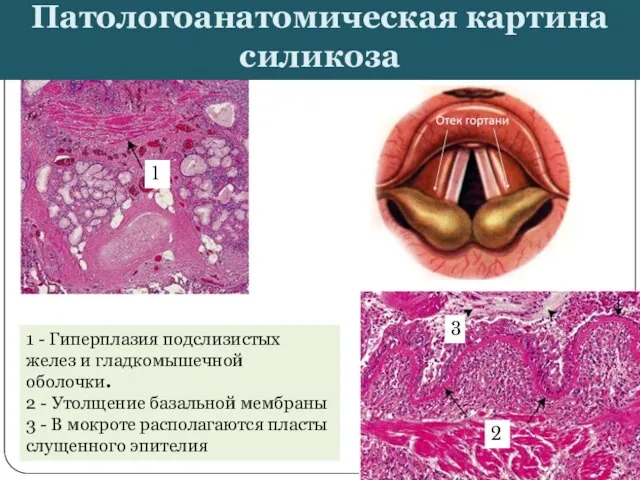 Патологоанатомическая картина силикоза 1 - Гиперплазия подслизистых желез и гладкомышечной оболочки. 2