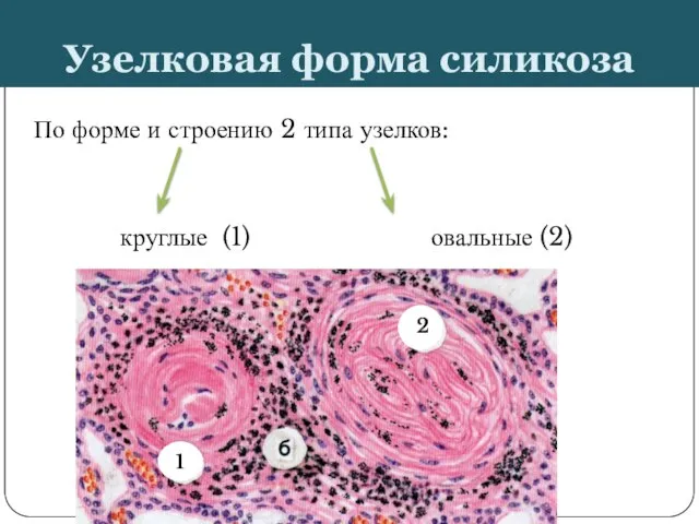 Узелковая форма силикоза По форме и строению 2 типа узелков: круглые (1) овальные (2) 1 2