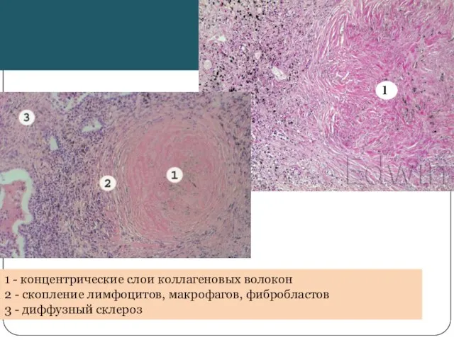 1 - концентрические слои коллагеновых волокон 2 - скопление лимфоцитов, макрофагов, фибробластов