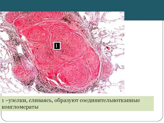 1 1 –узелки, сливаясь, образуют соединительнотканные конгломераты