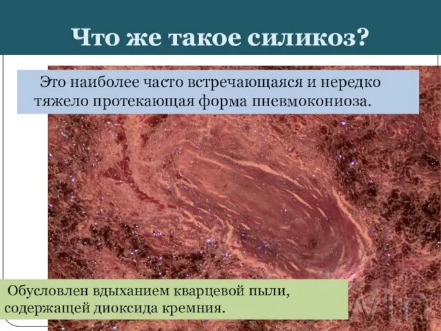 Что же такое силикоз? Это наиболее часто встречающаяся и нередко тяжело протекающая