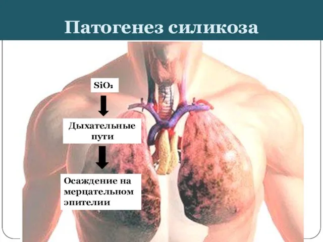 Патогенез силикоза SiO₂ Дыхательные пути Осаждение на мерцательном эпителии