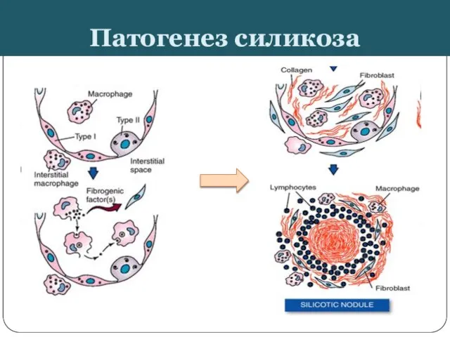 Патогенез силикоза