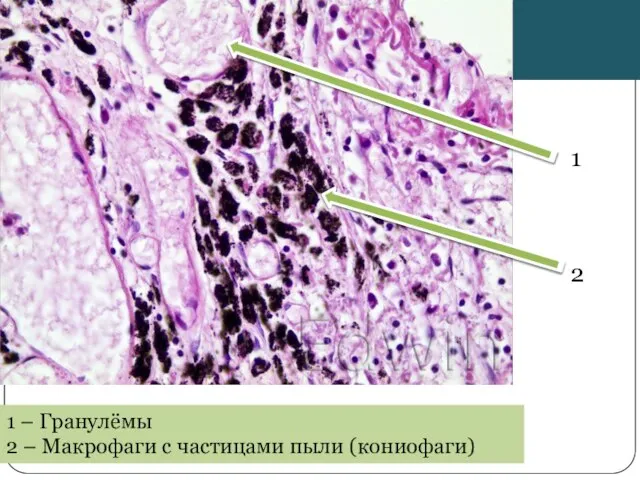 2 1 1 – Гранулёмы 2 – Макрофаги с частицами пыли (кониофаги)